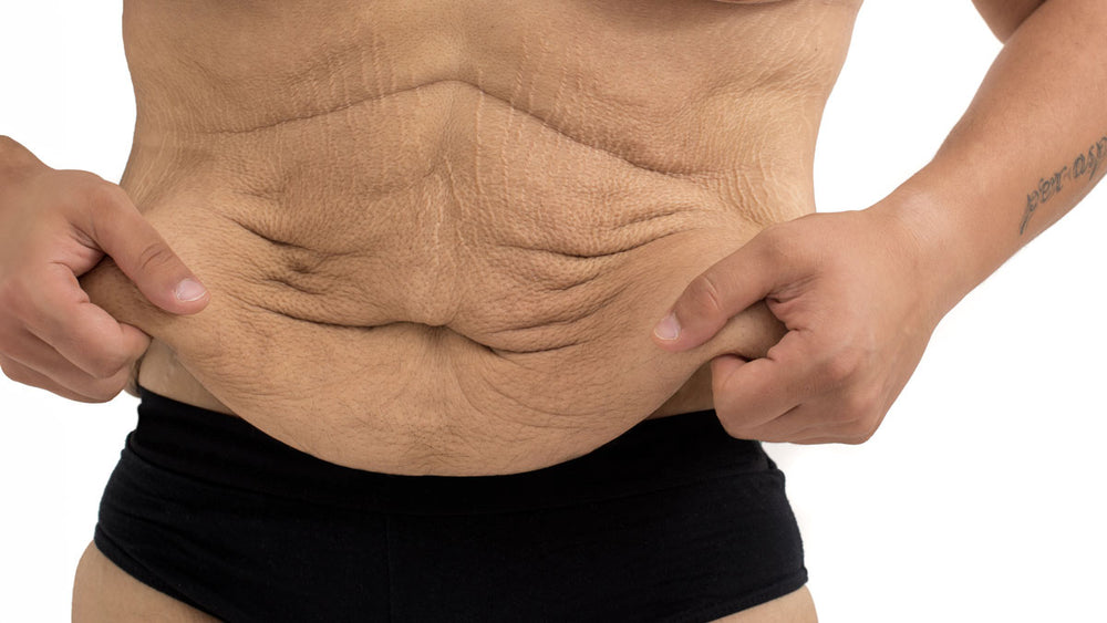 Skin in the Game: Strategies for Dealing with Loose Skin After Weight Loss