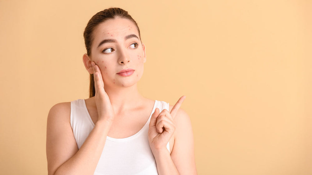 Acne and GERD: The Gut-Skin Link You Need to Know