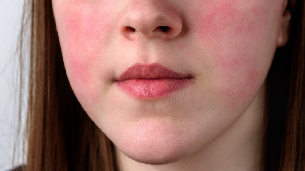Sulfite Sensitivity: Symptoms, Foods to Avoid, and How to Manage It